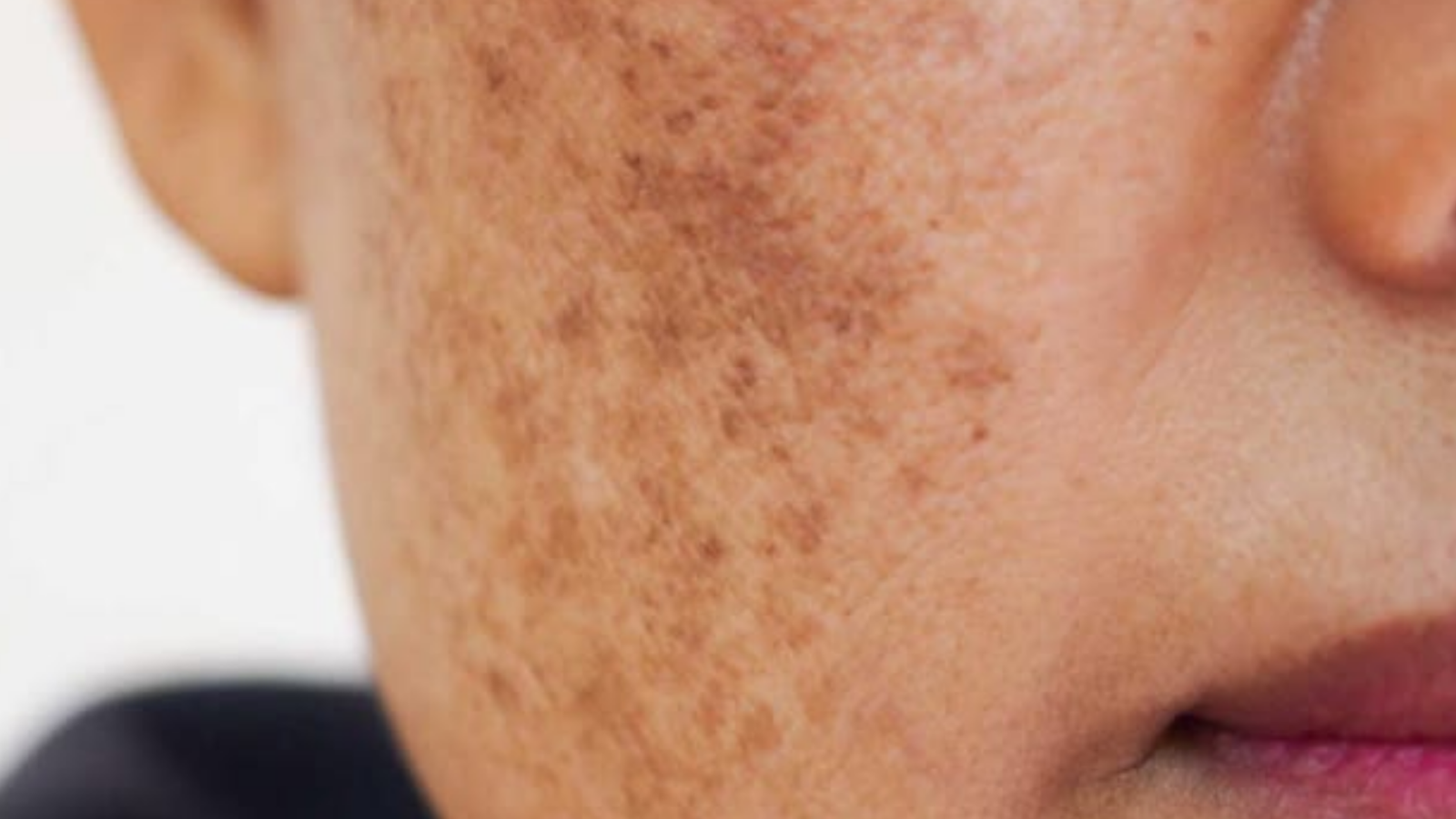 Esse é o cuidado indispensável para prevenir manchas, melasma e envelhecimento precoce